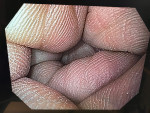 Olympus GIF-H170 Gastroscopy